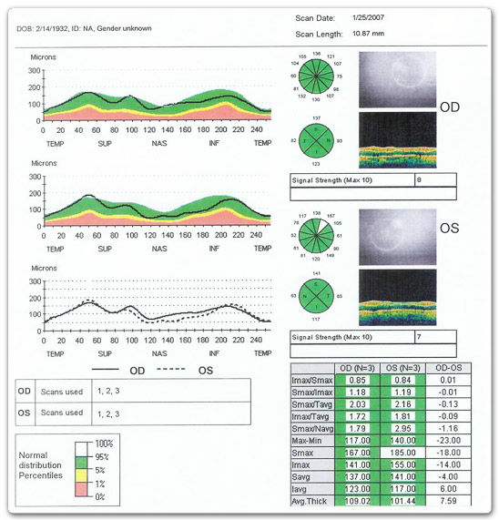 OCT-des-fibres-normal