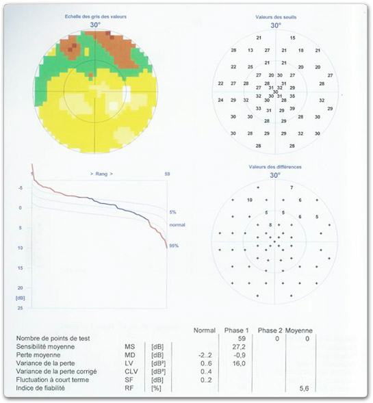 legere-atteinte-de-champ-visuel-_superieure_